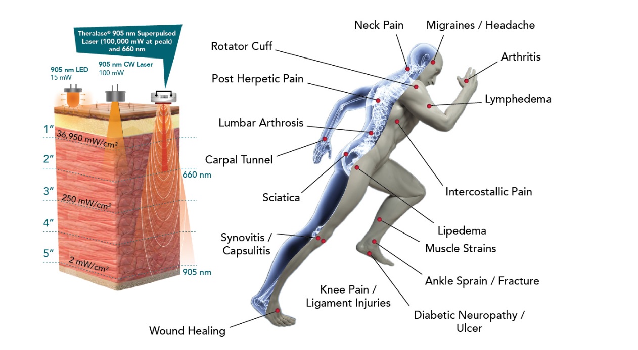 Photodynamic therapy tissue penetration and ulcer treatment areas